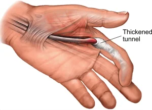 إصبع الزناد